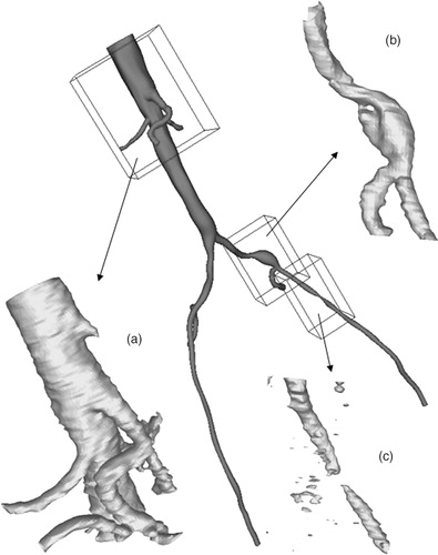 Figure 8. Anatomic variability caused by vascular disease. The preoperative solid model is shown (in red) with three views created from the MRA data using thresholding. (a) The celiac trunk is not patent because of advanced vascular disease. (b) A dissection near the branch of the left internal iliac artery. (c) A tight stenosis that causes the vessel to appear disjoint because of the limitations in the image resolution and the threshold value selected. [Color version available online]