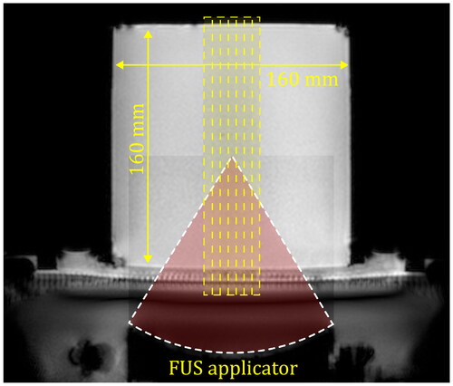Figure 1. MRI scan showing a sagittal slice of the phantom placed on top of the FUS applicator. The position of the seven slices that are acquired every 2.5 s are indicated by the yellow rectangles. The approximate acoustic beam path is indicated by the red circular sector.