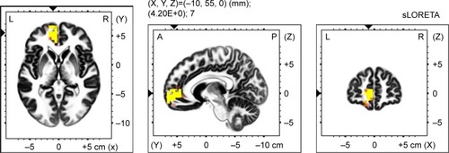 Figure 5 Voxel-wise statistical non-parametric map (SnPM) of sLORETA images in all patients (n=19) during imagery of an general anxiety scenario compare to resting state at the 0.05 significance level after correction for multiple comparisons. Yellow/red shades indicate increased beta-3 sources (red for P<0.1; yellow for P<0.05). Structural anatomy is shown in gray scale (A – anterior; P – posterior; L – left; R – right).