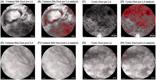 Figure 6. Confocal images acquired before (A) and after (E) LA in the common bile duct, and before (C) and after (G) ablation in the cystic duct. Image analysis evidenced the red mask plotted in correspondence to the cells visible in the images before (B) and after (F) LA in the common bile duct and before (D) and after (H) LA in the cystic ducts.