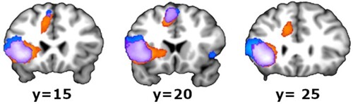 Figure 3. Medial view (medial frontal gyrus, whole brain results). In a more posterior section (y = 20, in the middle), there was an overlap (purple) and also some activity for phonotactics (blue, dorsally) and syntax (orange, ventrally), separately. In the lower sagittal plane of Figure 2, the locations of these three coronal planes are indicated. All clusters in the images are significant at corrected PFWE < 0.05.