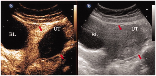 Figure 3. Contrast-enhanced ultrasonography (CEUS) was immediately performed to assess the effectiveness of WMA, and necrotic areas are shown as nonenhanced areas on CEUS. BL: bladder; UT: uterus. Red arrows indicate the area of the lesion.