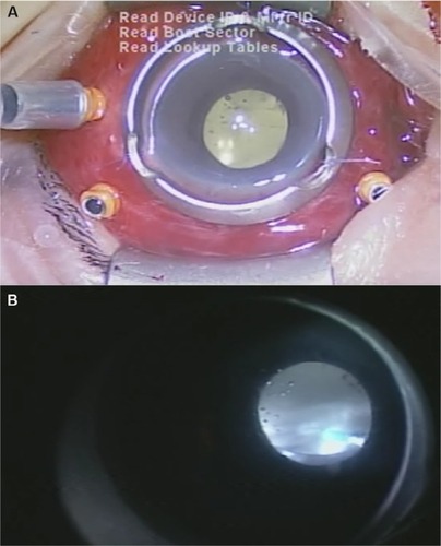 Figure 2 External appearance of the eye with severe chemosis and hyperemia (A) and vitreous opacity (B) observed intraoperatively.