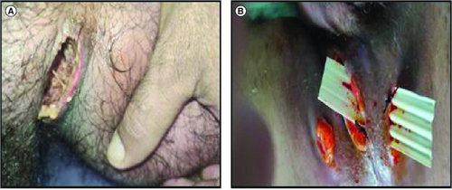 Figure 1. Initial appearance of the lesion in preoperative (A) and postoperative conditions (B).