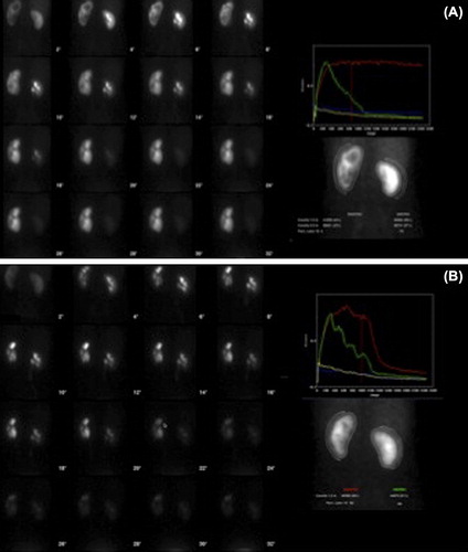 Figure 2. [99mTc] mercaptoacetylglycine (MAG3) renal scintigraphy indicating an obstructed pattern on the left kidney (A), which normalized after surgical intervention (B).