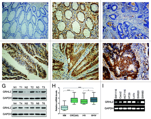 Figure 1. GRHL2 was overexpressed in CRC samples and associated with tumor progression. Immunohistochemical (IHC) staining of formalin-fixed, paraffin-embedded CRC tissues and paired non-tumor tissues was performed. Representative images illustrative of the different staining patterns are presented in (A–F). (A) Negative GRHL2 staining in no-tumor normal mucosa. (B) Nuclear staining of GRHL2 in no-tumor epithelium adjacent to CRC. (C) Negative staining of GRHL2 in CRC. (D) Weak nuclear intensity staining of GRHL2 in CRC. (E) Moderate nuclear staining of GRHL2 in CRC. (F) CRC sample showing strong nuclear staining for GRHL2. (G) Western blot analysis demonstrated GRHL2 expression was higher in six CRC specimens (T1–T6) compared with adjacent non-tumor specimens (N1–N6) relative to the loading control GAPDH. (H) Box plot depicting GRHL2 levels as assessed by qRT-PCR in the normal mucosa (NM) and our series of 75 CRC samples classified by according tumor stage (stage I+II, n = 30; stage III+ IV, n = 45). *indicates P < 0.05, *** indicates P < 0.001. (I) Semi-qRT-PCR analysis demonstrated GRHL2 expression was varied in seven different CRC cell lines.