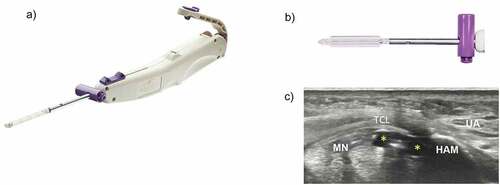 Figure 1. Carpal tunnel release with ultraGuideCTR and real-time ultrasound guidance. A. ultraGuideCTR device, consisting of hand piece and distal working tip. B. close-up view of device tip from ‘bird’s eye view’ demonstrating inflated balloons which increase the device diameter from 4 mm to 8 mm to create space within the carpal tunnel. C. cross-sectional view of the distal carpal tunnel with the device placed directly below the transverse carpal ligament (TCL) and between the median nerve (MN) and the hook of the hamate bone (HAM). the balloons (yellow asterisks) have been inflated to create space between the MN and the ulnar artery (UA). top = superficial, left = radial.