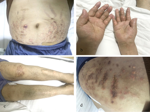 Figure 1. Cutaneous and subcutaneous manifestations of gout. (A) The skin on the abdomen has numerous partially ruptured soft miliary tophi papules with a gritty texture. (B) Subcutaneous deposits of white tophaceous material triggering swelling on the palmar area of both hands. (C) Tophi-laden papules and plaques affecting the joints and anterior tibial area. (D) Nodular tophaceous rash on the lower back, accompanied by pigmentation.