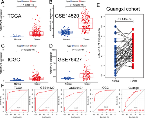 Figure 1 (A–E) Scatter plots illustrated the higher RAD51AP1 expression in HCC compared with normal liver tissues in the TCGA, GEO (GSE14520 and GSE76427), ICGC and Guangxi cohorts. (F) Diagnostic receiver operator curves with decent AUC values of RAD51AP1 for HCC diagnosis in various cohorts.