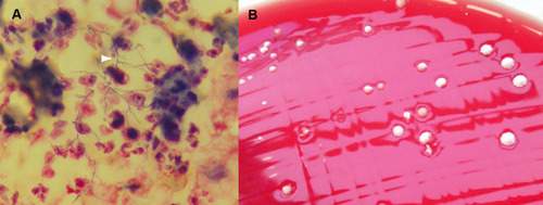 Figure 3 Microbiological diagnosis of nocardiosis. (A) Direct examination of a bronchoalveolar lavage (BAL) after Gram staining revealing filamentous Gram-positive bacteria (white arrowhead). (B) Positive culture of the same BAL on blood agar plate.