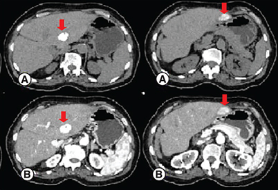 Figure 5. Follow-up abdominal CT taken one month after the second session of transarterial chemoembolization.The CT showed a dense and homogeneous lipiodol deposition in the tumor on precontrast images (red arrow in [A]), without persistent arterial phase hyperenhasement (red arrow in [B]).