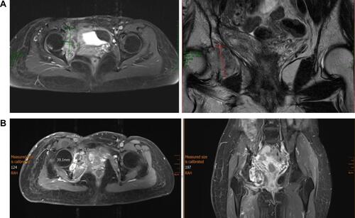Figure 2 (A) MRI images taken 04 Jan 2020 showing mass near right acetabulum. (B) MRI images take 01 Jun 2020 showing a heterogeneously enhancing mass arising from the right acetabulum, extending into the right hip joint.