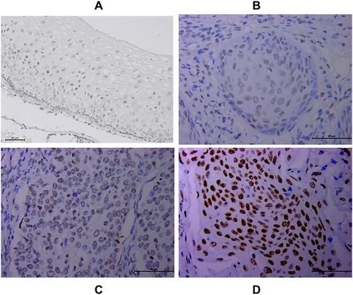 Figure 1 Increased HSF1 expression in cervical cancer tissues (CTT) via immunohistochemistry. HSF1 staining was mainly localized in the nucleus of cells. (A) Normal CTT. (B) Well-differentiated CTT. (C) Moderately differentiated CTT. (D) Poorly differentiated CTT.