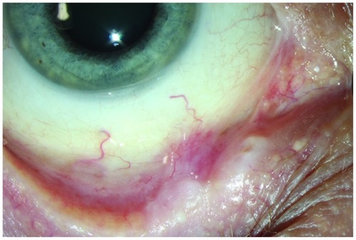 Figure 3 Slit lamp photograph taken 9 months after initiation of phlebotomy treatments, showing significantly reduced inflammation.