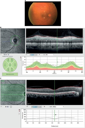 Figure 3 Retinal images 2 weeks after the injection.