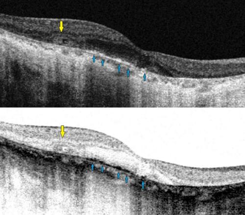 Figure 6 Spectral domain-optical coherence tomography (SD-OCT) image revealing both outer retinal tabulation (blue arrow) and crystalline macular deposits (yellow arrow) of a BCD individual.