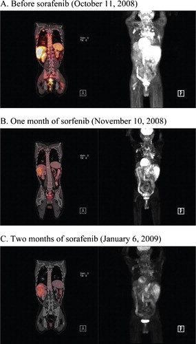 Figure 1. PET scans (left panel) show a pronounced decrease of metabolic activity of metastatic nodules within the patient's bones, lungs and liver. Right panels reveal a dramatic decrease in the size and number of metastatic nodules in the lungs, mediastinum, thoracolumbar vertebral column, periaortic lymph nodes, left axilla, liver and sternum.