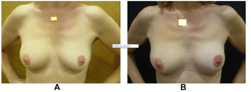 Figure 5 Patient before (A) and after (B) contralateral breast augmentation to address asymmetry after PBR with CWPF. The augmentation was performed 2 years after completion of cancer treatment.