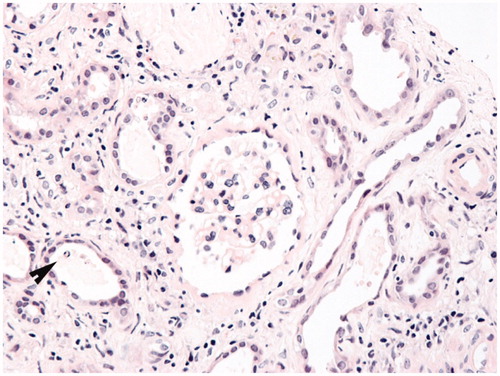 Figure 4. Biopsy shows simplification of the epithelial lining of renal tubules. Some renal tubules contain debris (arrowhead). Hematoxylin and eosin, original magnification ×200.