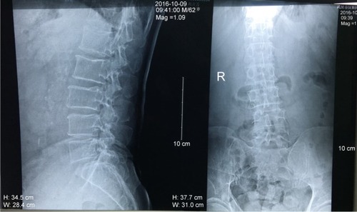Figure 2 Plain X-ray films of the lumbar spine showing no obvious abnormalities except slight degenerative lumbar scoliosis (anteroposterior view on the left and lateral view on the right).