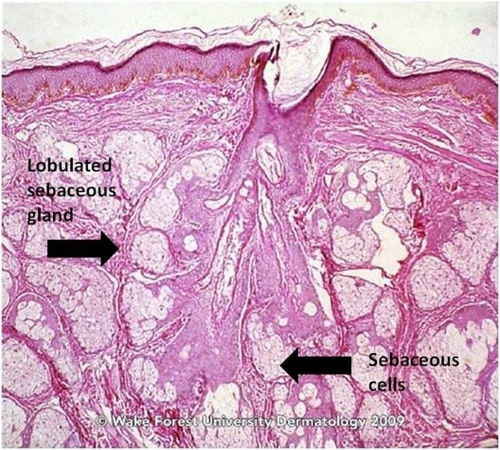 Figure 2 Sebaceous gland of a young adult.Source: Graham Library of Digital Images, Wake Forest University Department of Dermatology. © 2009 Wake Forest University Dermatology.