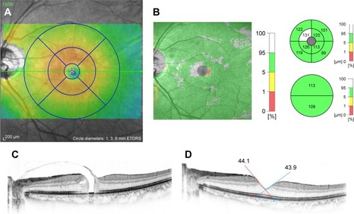 Figure 2 SD-OCT images of a 62-year-old woman with stage 3 MH after PPV without peeling of the ILM.