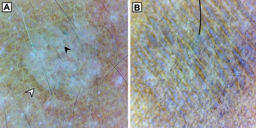 Figure 2 (A) Dermoscopy (original magnification 10×) of hypopigmented lesion showing nonuniform pigmentation, inconspicuous ridges and furrows, perilesional hyperpigmentation (white arrowhead) and patchy scaling (black arrowhead). (B) Dermoscopy (original magnification 10×) of hyperpigmented lesion showing non-uniform pigmentation.
