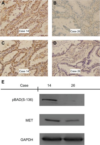 Figure 2 Immunohistochemical staining and Western blotting for MET and phospho-BAD(Ser-136) in adenocarcinoma of the lung. (A and B) Positive and negative staining of MET in adenocarcinoma. Case 14 shows strong cytoplasmic/membrane staining, whereas case 26 shows only weak cytoplasmic staining. (C and D) Positive and negative staining of phospho-BAD(Ser-136) in adenocarcinoma. Case 14 shows strong cytoplasmic staining, whereas case 26 shows only weak cytoplasmic staining. (E) Western blotting with MET and phospho-BAD(Ser-136) expression in cases with adenocarcinoma of the lung, indicating increased phospho-BAD(Ser-136) detection in the case with positive expression of MET by immunohistochemistry. Magnification ×400.