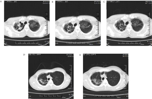 Figure 3. (A through E): Short-term follow-up HRCT images of patients with Mycobacterium paragordonae pulmonary disease; (A): HRCT images at the initial diagnosis in case 6; (B) HRCT images after the end of anti-tuberculosis treatment in case 6; (C) HRCT images 2 years after cessation of treatment in case 6; (D, E) HRCT images at the initial diagnosis and after 9 months of follow-up in case 8, respectively.