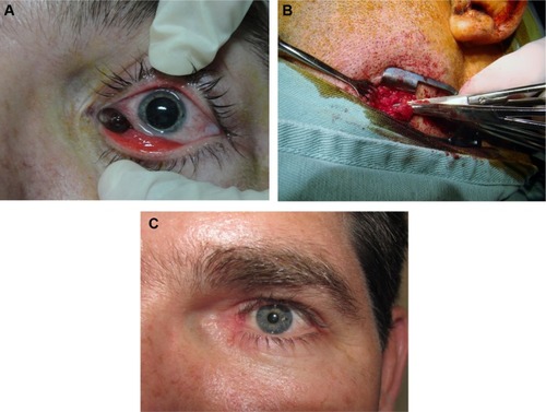 Figure 2 Conjunctival melanoma before and after excision (case 3). (A) Excision of the lesion. (B) Identification of the submandibular lymph node. (C) Postoperative result.