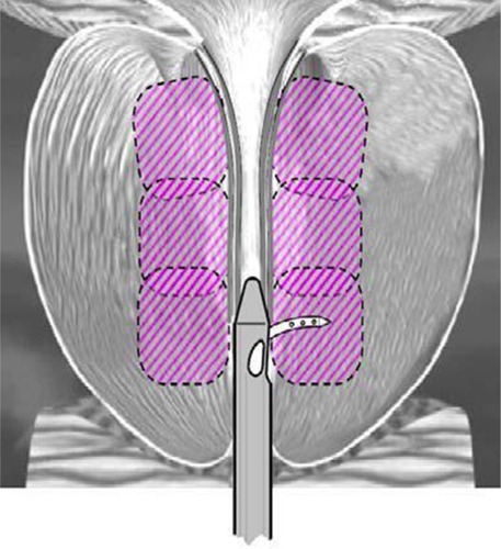 Figure 1 Schematic of contiguous ablation zones in the prostate after convective RF water vapor thermal therapy; example shows 3 treatments per side.