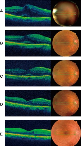 Figure 1 Vertical sections of optical coherence tomography