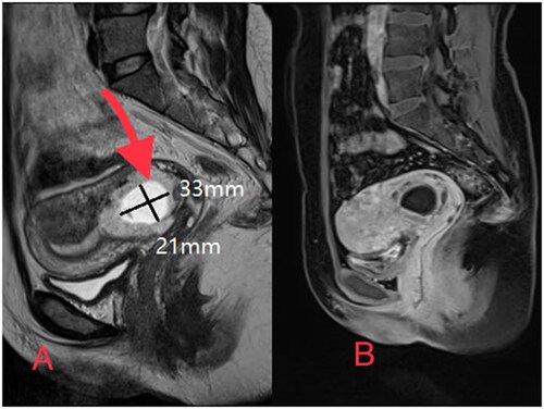 Figure 2. MRI from a patient with cervical pregnancy. (A) A sagittal view of T2-Weighted image showing a gestational sac in the cervix (red arrow). (B) A sagittal view of contrast enhanced MRI showing no enhancement in the gestational sac.