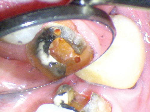 Figure 37. 2 canals found using the endo guide.