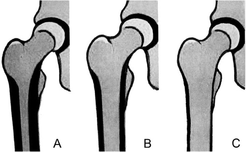 Figure 1.  Dorr femoral bone classification. Type A: narrow canal with thick cortical walls (champagne flute canal). Type B: moderate cortical walls. Type C: wide canal with thin cortical walls (stove-pipe canal).