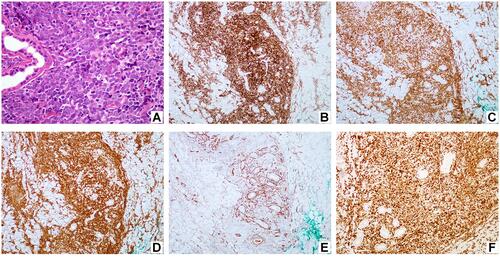 Figure 2 Morphologic features of the skin lesion. (A) The core needle biopsy specimen is extensively replaced with tumor cells characterized by nucleoli and scant cytoplasm (H&E, 400x). (B–D) Immunohistochemical stains show that tumor cells were positive for CD20 ((B), 100x), PAX5 ((C), 100x), and TdT ((D), 100x). (E) Immunohistochemical stains show that tumor cells were negative for CD34 (100x). (F) About 90% of the neoplastic cells display nuclear Ki67 staining (100x). TDT, terminal deoxynucleotidyl transferase.