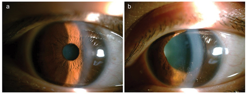 Figure 1. Patient 1 was diagnosed as anterior uveitis of left eye. She received both topical and a fast systemic tapering dose of glucocorticoids due to the severe symptom. (a) Showed normal anterior segment of right eye. (b) Showed anterior inflammation and irregular pupil of left eye.