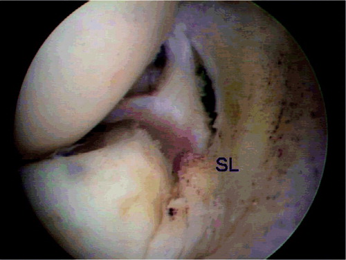 Figure 3. Final arthroscopic findings. The shrunk ligament (SL) can be seen on the right-hand side. This structure is tight during hook palpation. The joint space is reduced. The lateral pivot shift sign is negative after the treatment.