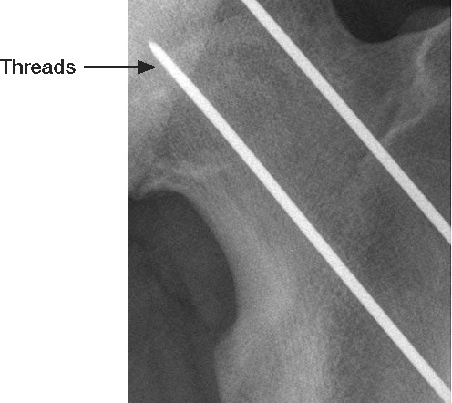 Figure 1. Steinmann pin with threads in the medial 8-mm tip.
