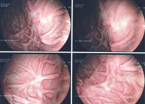 Figure 5 Upper gastrointestinal endoscopy 4 weeks after liposomal amphotericin B, showing numerous scarred stellar lesions sometimes with retraction of the greater gastric tuberosity and anterior wall.
