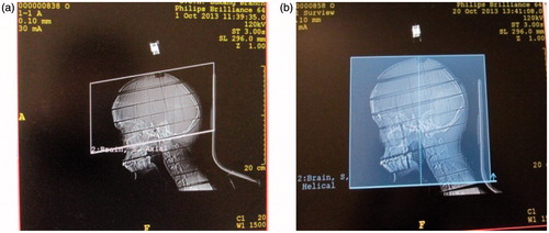 Figure 2. Scout view of two protocols obtained at Phillips Brillance 128-slice. (a) Axial scan: maxillae from external auditory meatus to parietal bone. (b) Helical scan: from mandible to parietal bone.