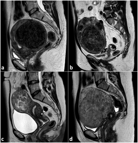 Figure 7. Representative MRI images (T2-w, sagittal plane) of large uterine fibroids show different signal intensities of the fibroids according to the Funaki classification scheme: Funaki type 1 (a) with very low T2-w intensity comparable to that of skeletal muscle, low vascularization; Funaki type 2 (b) with T2-w intensity between that of skeletal muscle and myometrium; Funaki type 3 (c, d) with heterogeneous T2-w intensity equal to or higher than that of the myometrium.