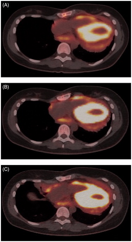 Figure 2. PET-CT images (A) after three treatment cycles (D755), (B) after seventeen treatment cycles (D1133) and (C) after thirty-six treatment cycles (D1812). The strong fluorodeoxyglucose F 18 uptake of the left ventricle is seen as an oval yellow ring. The uptake had become more pronounced in the pericardium in conjunction with disease progression (images B and C). The used treatments have been listed in Table 1.