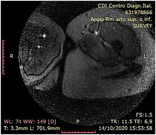 Figure 2. Preoperative MRI.