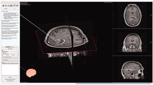 Figure 10. Initial validation of Tactics was performed through surgeons planning biopsies using Tactics alongside their standard techniques. Here, a neurosurgeon plans a target and trajectory for a brain tumor biopsy using Tactics.