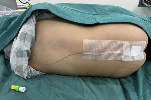 Figure 2 The back of one patient containing the catheter after continuous sacral block.