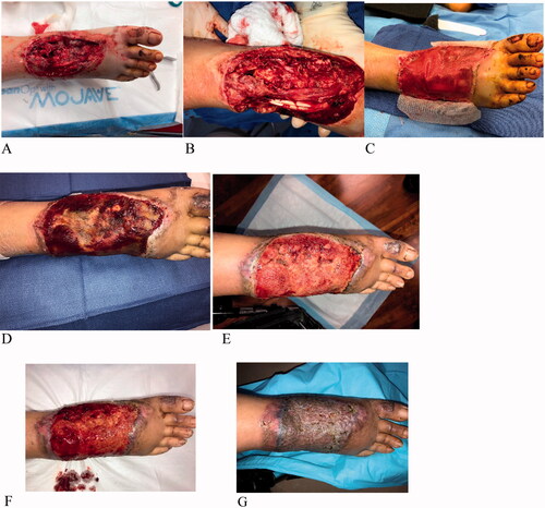 Figure 3. Case 3. A 48-year-old female admitted to the hospital after a scooter crash. She suffered a lower extremity right dorsal foot wound with exposed bone and tendons. The wound was debrided twice prior to matrices placement (A, B). IWM Thin was stacked over the wound bed to allow for rapid incorporation over the exposed vital structures, and a sheet of IMBWM was applied over the wound (C). Vascularization of the matrices occurred sequentially after matrices placement; partial vascularization at 3 weeks (D), improved vascularization at 5 weeks (E). The vascularization was robust at 6 weeks (F), at which time the silicon layer was removed and STSG was applied. The wound was completely healed and showed good cosmesis 3 months after skin grafting (G).