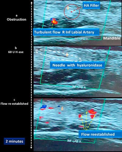 Figure 17 Ultrasound-guided Hyaluronidase treatment illustrating resolution of obstruction over 2 minutes (60 IU) Hyaluronidase. Note: Ultrasound images courtesy of Dr Stefania Roberts.