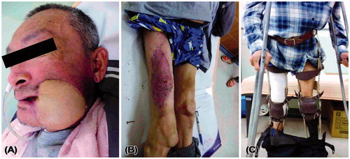 Figure 6. At a follow-up of one month in Case 2, the patient was satisfied with the reconstructed cheek (A) without donor site complications (B), and he could walk well with calipers and crutches (C).