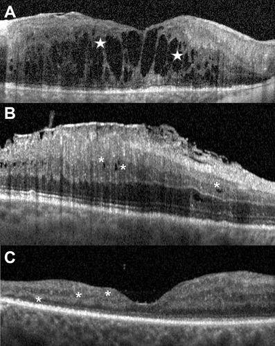 Figure 1. A: cross-sectional macular OCT horizontal scan of an eye with exudative maculopathy: the hyporeflective roundish cystoid spaces in the inner nuclear layer may merge (white stars) with those located in the Henle fibre layer-outer nuclear layer. B: cross-sectional macular OCT horizontal scan of an eye with tractional maculopathy: in this eye affected with a tractional epiretinal membrane, multiple hyporeflective round inner nuclear layer cystoid spaces (white asterisks) do not extend deeper in the retina or past the Henle fibre layer boundary. No outer retinal disruption is visible. C: cross-sectional macular OCT horizontal scan of an eye with macular atrophy. No intraretinal hyporeflective round cystoid spaces are found and all retinal layers of the macula are thinned (white asterisks).